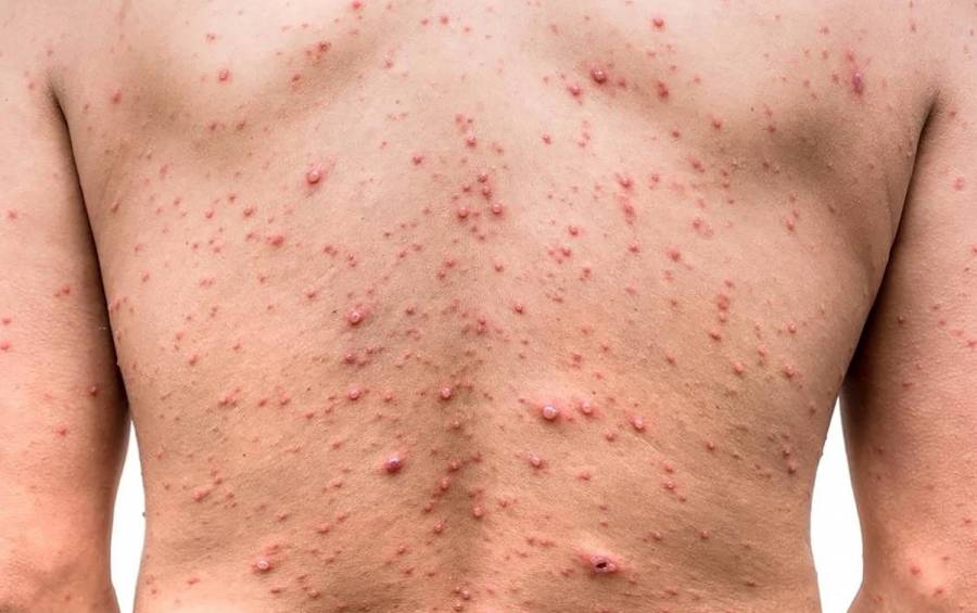 No hay casos de “viruela s&iacute;mica” en el Estado de M&eacute;xico, informan autoridades epidemiol&oacute;gicas